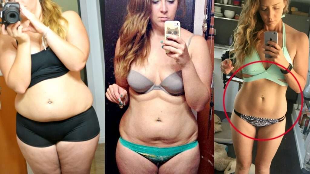 How Can I Prevent Loose Skin During Weight Loss